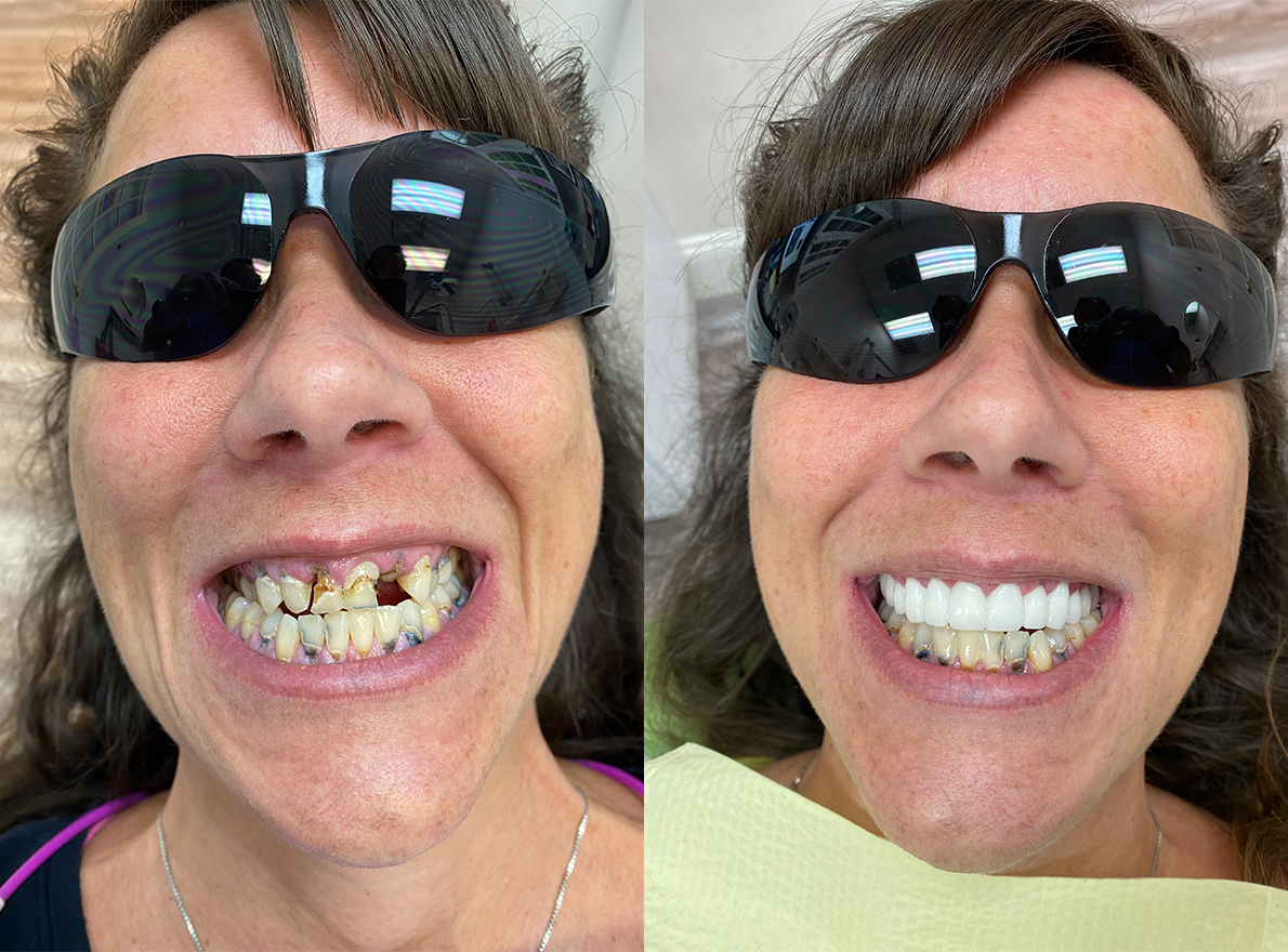 Pasco Dental | Dental Lab, Snoring Appliances and Night Guards